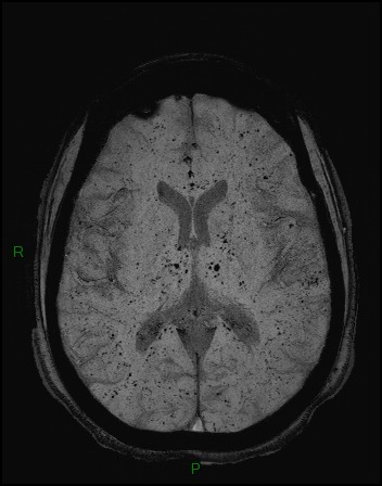 Cerebral fat embolism (Radiopaedia 35022-36525 Axial SWI 22).jpg