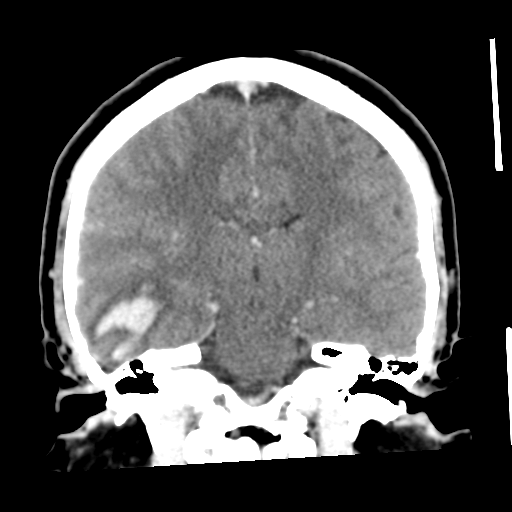 Cerebral hemorrhage secondary to arteriovenous malformation (Radiopaedia 33497-34561 C 37).png