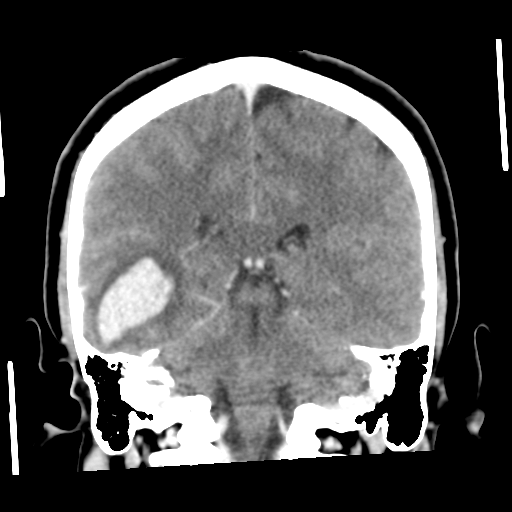 Cerebral hemorrhage secondary to arteriovenous malformation (Radiopaedia 33497-34561 C 42).png