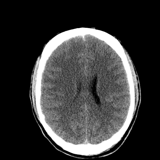 File:Cerebral hemorrhagic contusions- temporal evolution (Radiopaedia 40224-42753 Axial non-contrast 21).png