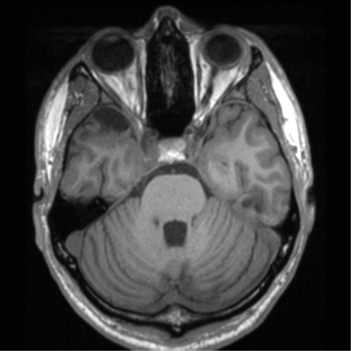 File:Cerebral hemorrhagic contusions- temporal evolution (Radiopaedia 40224-42757 Axial T1 24).png