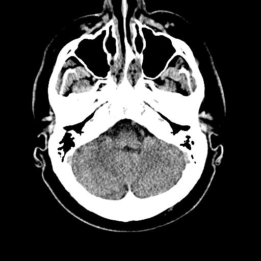 File:Cerebral hemorrhagic contusions and cervical spine fractures (Radiopaedia 32865-33841 Axial non-contrast 8).jpg