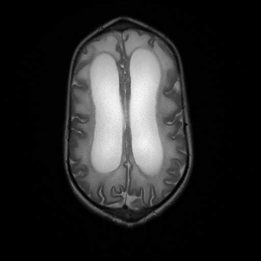 File:Cerebral manifestations of mucopolysaccharidosis type I (Radiopaedia 59171-66487 Axial T2 16).jpg