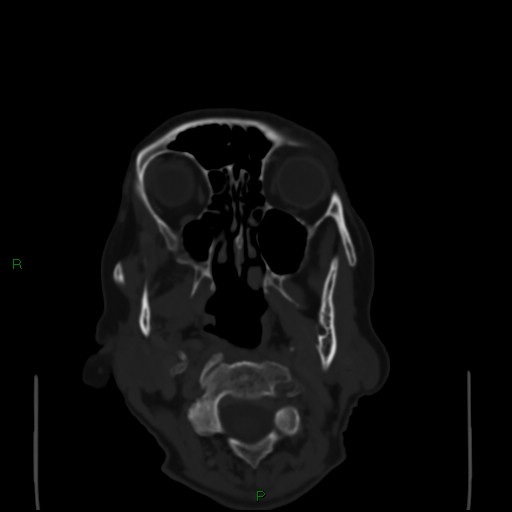 Cerebral metastases - breast primary (Radiopaedia 77653-89857 Axial bone window 4).jpg