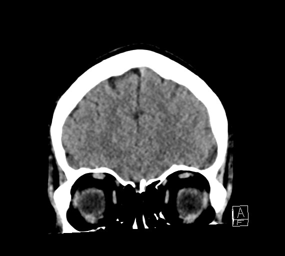 Cerebral metastases - testicular choriocarcinoma (Radiopaedia 84486-99855 Coronal C+ delayed 14).jpg