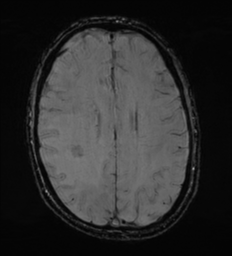 Cerebral metastasis - melanoma (Radiopaedia 54718-60954 Axial SWI 38).png