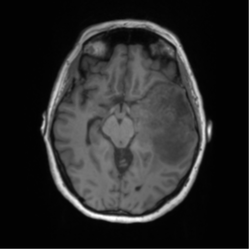 Cerebral metastasis mimicking glioblastoma (Radiopaedia 69155-78937 Axial T1 25).png