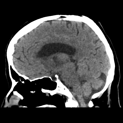 Cerebral metastasis to basal ganglia (Radiopaedia 81568-95412 E 34).png