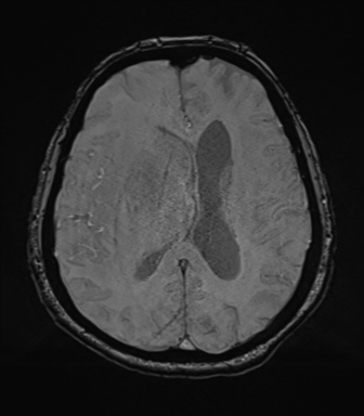 Cerebral metastasis to basal ganglia (Radiopaedia 81568-95413 Axial SWI 52).png