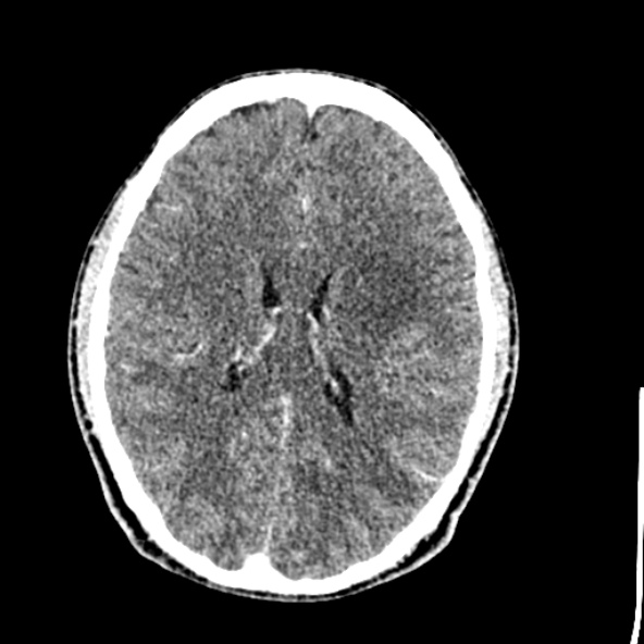 Cerebral toxoplasmosis (Radiopaedia 53993-60131 Axial C+ delayed 44).jpg