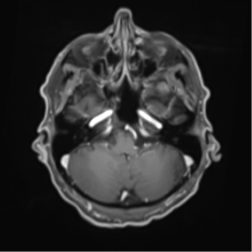 Cerebral toxoplasmosis (Radiopaedia 54575-60804 Axial T1 C+ 14).png
