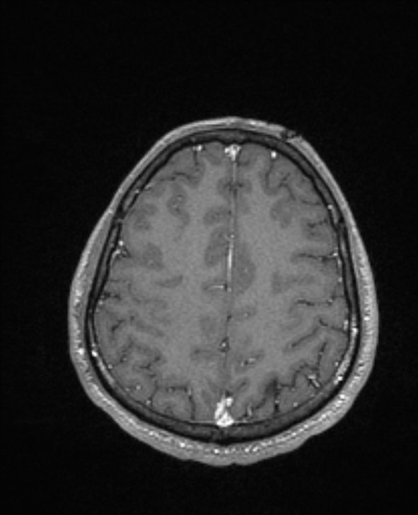 Cerebral toxoplasmosis (Radiopaedia 85779-101597 Axial T1 C+ 125).jpg