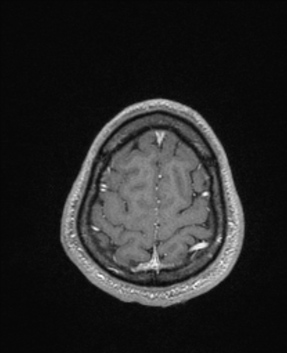 Cerebral toxoplasmosis (Radiopaedia 85779-101597 Axial T1 C+ 142).jpg