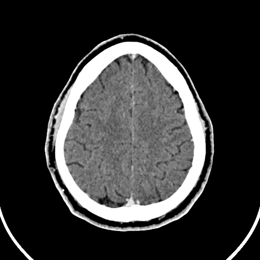 File:Cerebral venous angioma (Radiopaedia 69959-79977 B 83).jpg