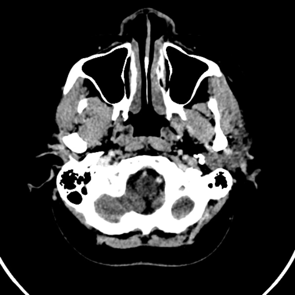 Cerebral venous hemorrhagic infarct from venous sinus thrombosis (Radiopaedia 55433-61883 Axial C+ delayed 135).jpg