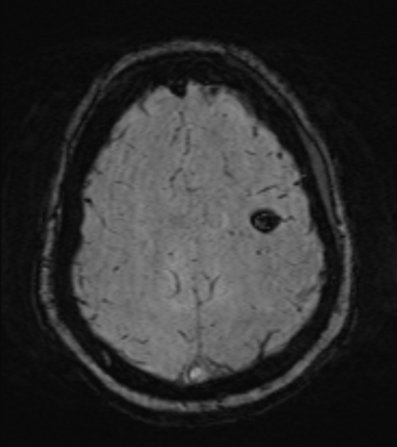 Cerebral venous infarct (Radiopaedia 53627-59685 Axial SWI 42).jpg