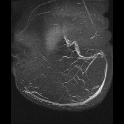 Cerebral venous infarction (Radiopaedia 25109-25396 MRV 19).jpg