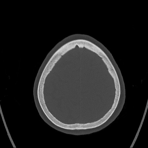 Cerebral venous infarction with hemorrhage (Radiopaedia 65343-74381 Axial bone window 161).jpg