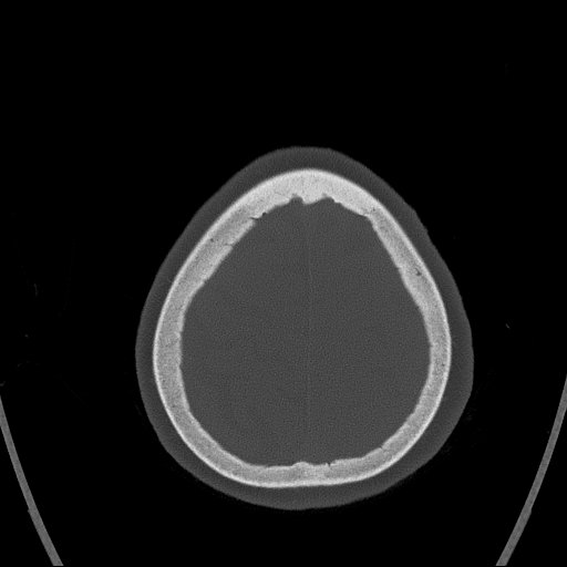 Cerebral venous infarction with hemorrhage (Radiopaedia 65343-74381 Axial bone window 167).jpg