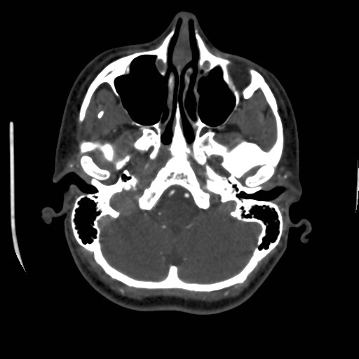 Cerebral venous sinus thrombosis (Radiopaedia 40619-43227 A 40).jpg