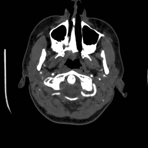Cerebral venous sinus thrombosis (Radiopaedia 40619-43227 A 9).jpg