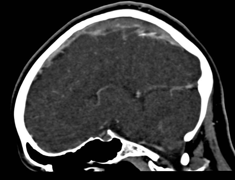 Cerebral venous sinus thrombosis (Radiopaedia 59224-66646 Sagittal C+ delayed 20).jpg