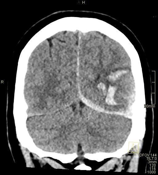 File:Cerebral venous sinus thrombosis (Radiopaedia 91329-108965 Coronal non-contrast 46).jpg