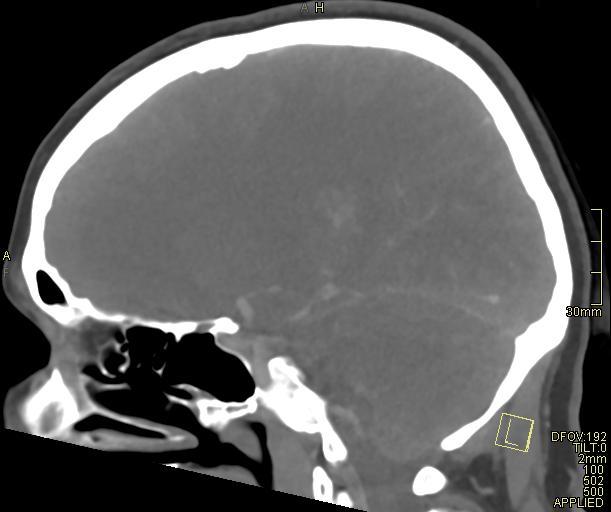 Cerebral venous sinus thrombosis (Radiopaedia 91329-108965 Sagittal venogram 45).jpg