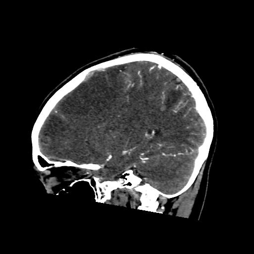 File:Cerebral venous throbmosis - hemorrhagic venous infarction (Radiopaedia 87318-103613 Sagittal CT venogram 15).jpg
