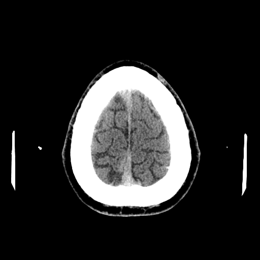 File:Cerebral venous thrombosis (CVT) (Radiopaedia 77524-89685 Axial non-contrast 43).jpg