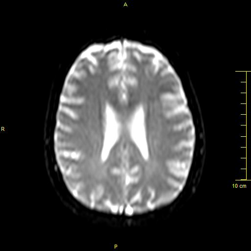 File:Cerebral venous thrombosis (Radiopaedia 23288-23351 Axial DWI 26).JPG