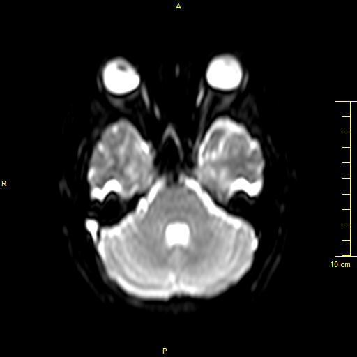 File:Cerebral venous thrombosis (Radiopaedia 23288-23351 Axial DWI 8).JPG