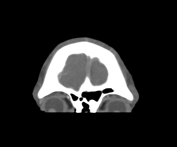Cerebral venous thrombosis (Radiopaedia 38392-40467 Coronal CTA-Venogram 8).png