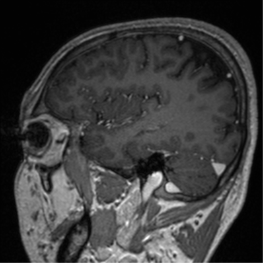 File:Cerebral venous thrombosis (Radiopaedia 38392-40469 Sagittal T1 C+ 26).png