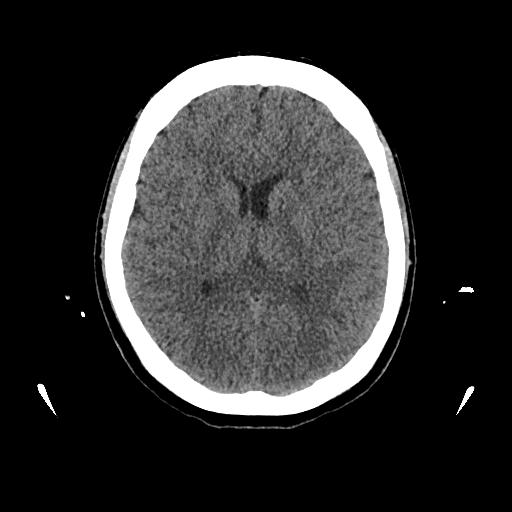 Cerebral venous thrombosis with venous hemorrhagic infarct (Radiopaedia 90354-107660 Axial non-contrast 29).jpg