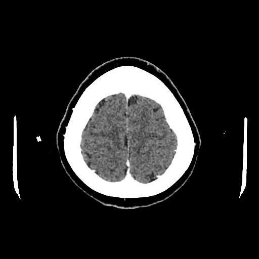 Cerebral venous thrombosis with venous hemorrhagic infarct (Radiopaedia 90354-107660 Axial with contrast 146).jpg
