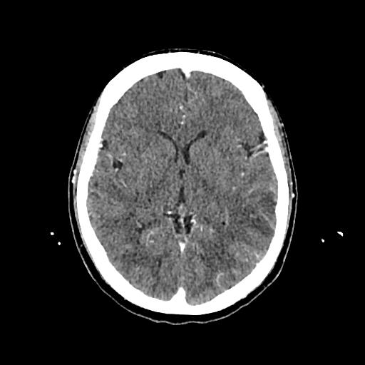 File:Cerebral venous thrombosis with venous hemorrhagic infarct (Radiopaedia 90354-107660 Axial with contrast 83).jpg