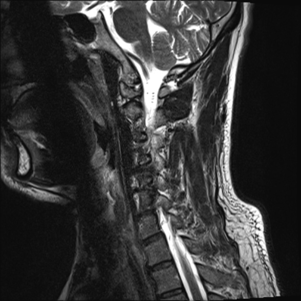 File:Cervical disc extrusion (Radiopaedia 53950-60077 Sagittal T2 13).jpg