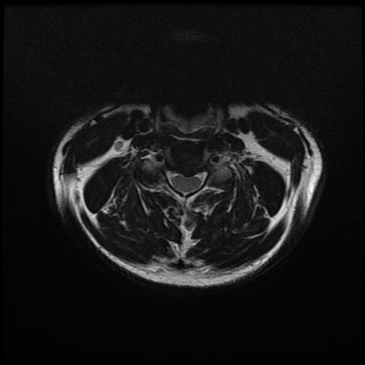 File:Cervical disc extrusion (Radiopaedia 59074-66364 Axial T2 6).jpg