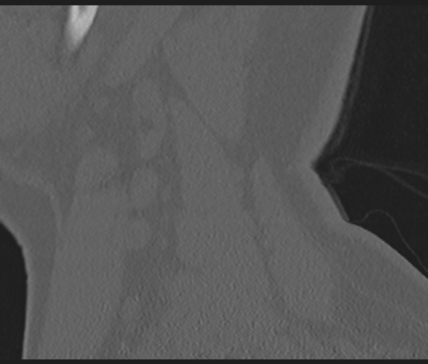 Cervical disc replacement (Radiopaedia 44025-47541 Sagittal bone window 9).png