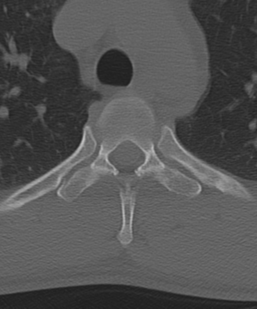 Cervical intercalary bone (Radiopaedia 35211-36748 Axial bone window 78).png