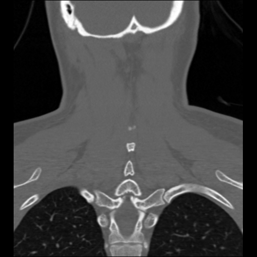File:Cervical rib (Radiopaedia 71110-81363 Coronal non-contrast 14).jpg