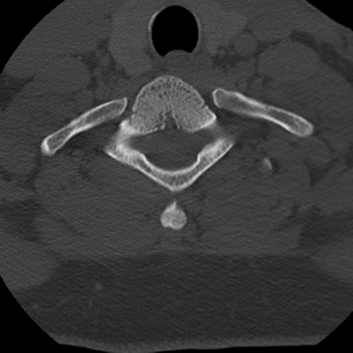 Cervical schwannoma (Radiopaedia 57979-64974 Axial bone window 41).png