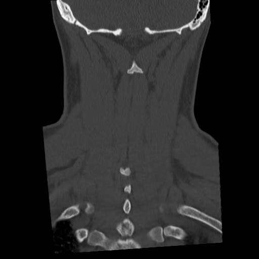 Cervical schwannoma (Radiopaedia 57979-64974 Coronal bone window 46).png