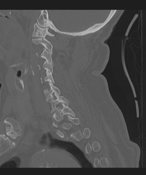 Cervical spine fracture in the setting of ankylosis (Radiopaedia 37038-38715 Sagittal bone window 29).png