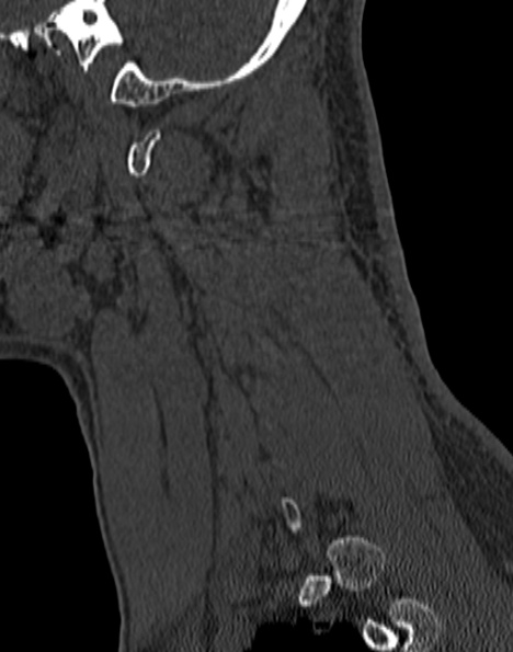Cervical spondylodiscitis (Radiopaedia 28057-29489 Sagittal bone window 16).jpg
