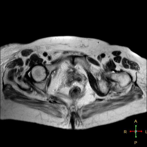 File:Cervical stump squamous cell carcinoma (Radiopaedia 48049-52858 Axial T2 2).jpg