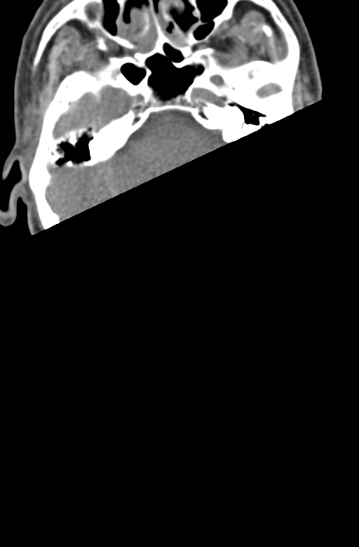 Chalk stick fracture (Radiopaedia 57948-64928 Axial non-contrast 2).png