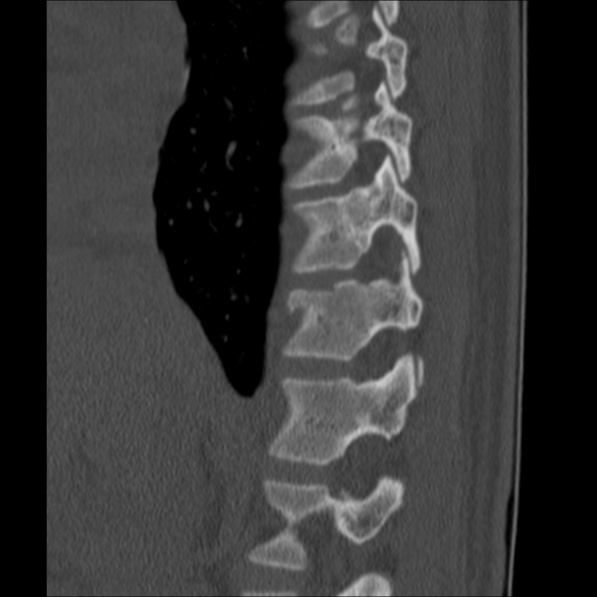 Chance fracture (Radiopaedia 36521-38081 Sagittal bone window 17).jpg