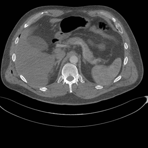 File:Chest multitrauma - aortic injury (Radiopaedia 34708-36147 A 295).png